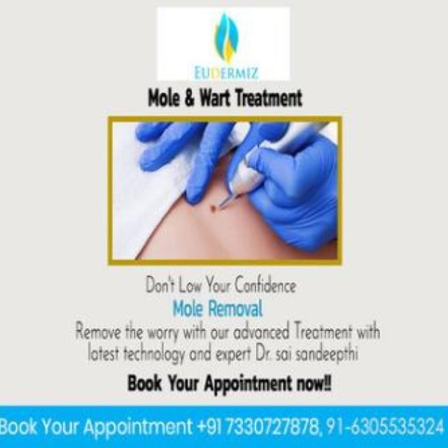 Eudermiz Treat Mole & Warts in Hyderabad