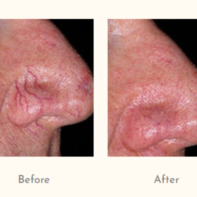 Spider Veins Treatment at Dr Simple Aher Clinic