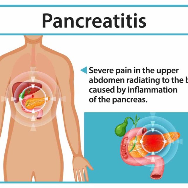 The Top 7 Ozempic Pancreatitis Symptoms You Need to Be Aware Of