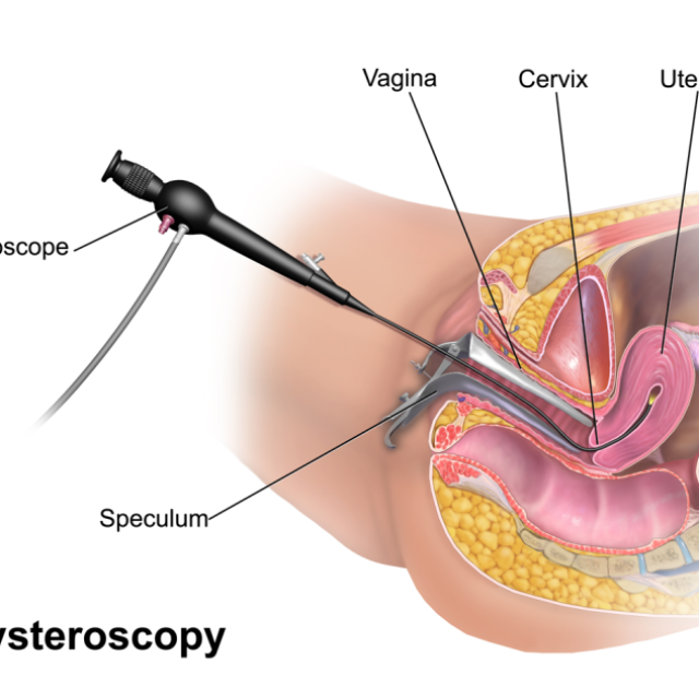 Hysteroscopy in Mumbai: Quality Care, Affordable Cost