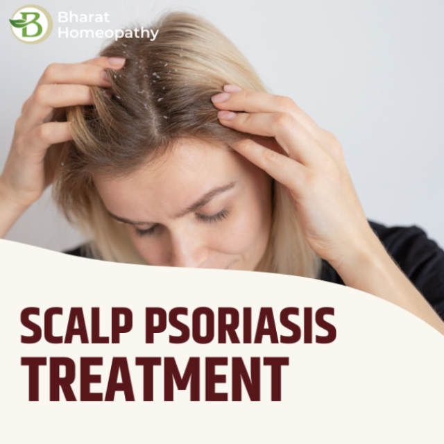 Natural Scalp Psoriasis Treatment: Simple Ways to Heal Your Skin