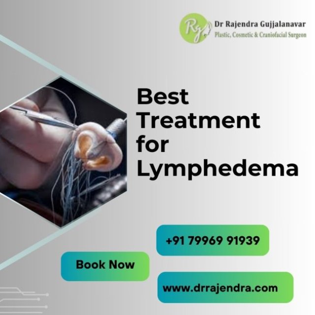 Best Treatment for Lymphedema | Expert Care & Solutions