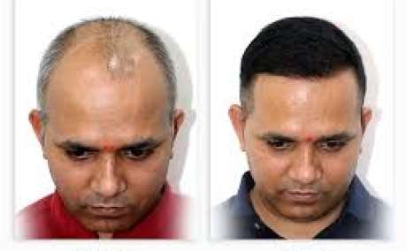 Best hair transplant in Nashik | Dr. Pranay Thakur