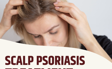 Natural Scalp Psoriasis Treatment: Simple Ways to Heal Your Skin