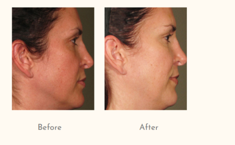 Laser Hair Reduction