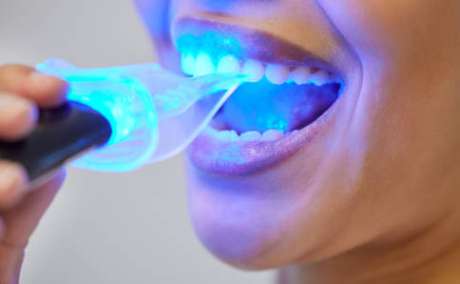Zoom teeth whitening -BEDC