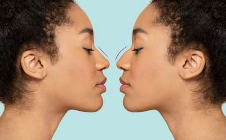 Best rhinoplasty Dubai | Dr Juan Carlos