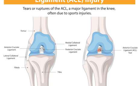 ACL Surgery Dubai | Dr Rik Kundra