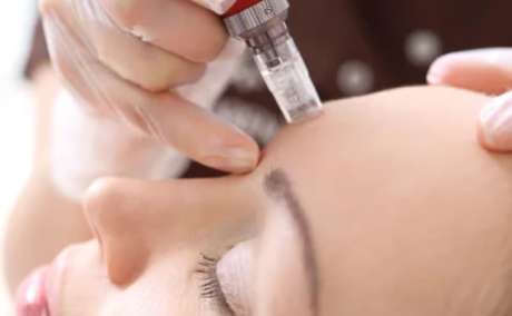 Dermapen Mesotherapy in Sharjah
