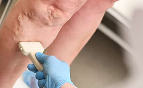 Varicose vein treatment in Pune | Karishma Vein Clinic Pune