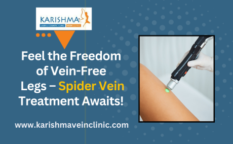 Spider Veins Treatment in Pune - Karishma Vein