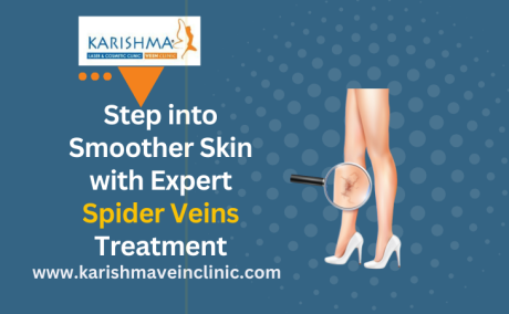 Treat Spider Veins on Feet & Ankles