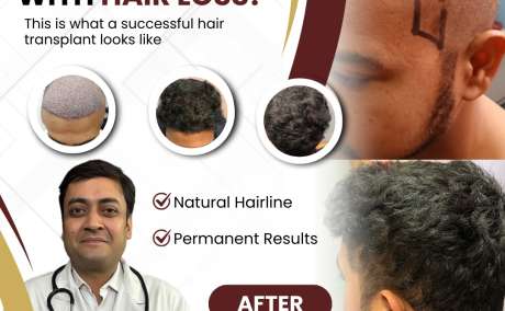 Struggling With Hair Fall?