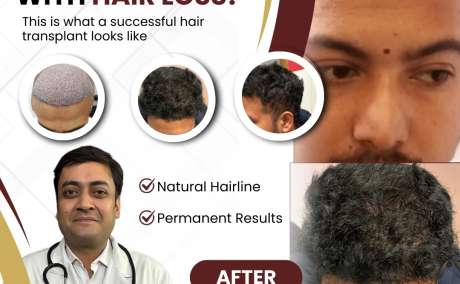 Hair Transplant: The Trending Permanent Solution for Hair Loss in 2026