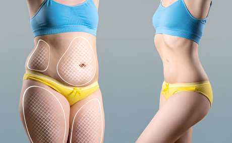 Tummy tuck in Dubai - Dr Juan Carlos