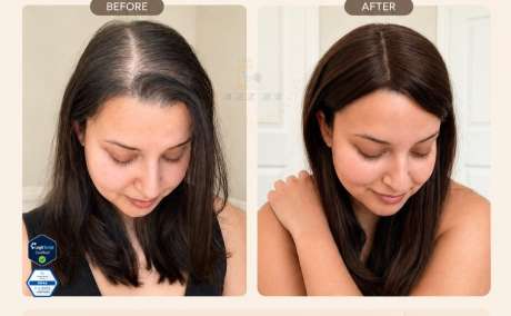 Women's Hair Loss Medication: What Actually Works, What the Data Says, and How to Start