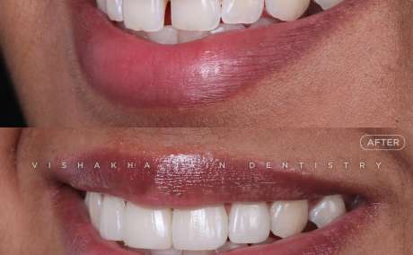 RCT Best Treatment in Indore - Comfortable Root Canal Care